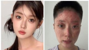 담뱃불에 가스 ‘펑’…전신화상 입은 中 뷰티 인플루언서